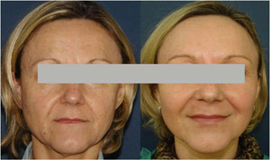 Фракционный фототермолиз кожи. Фото до и после. Клиника VITAL.